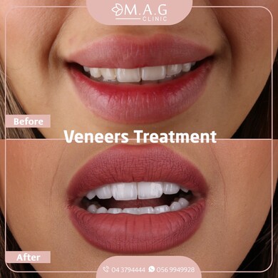 Our Best Veneers Offer to date!